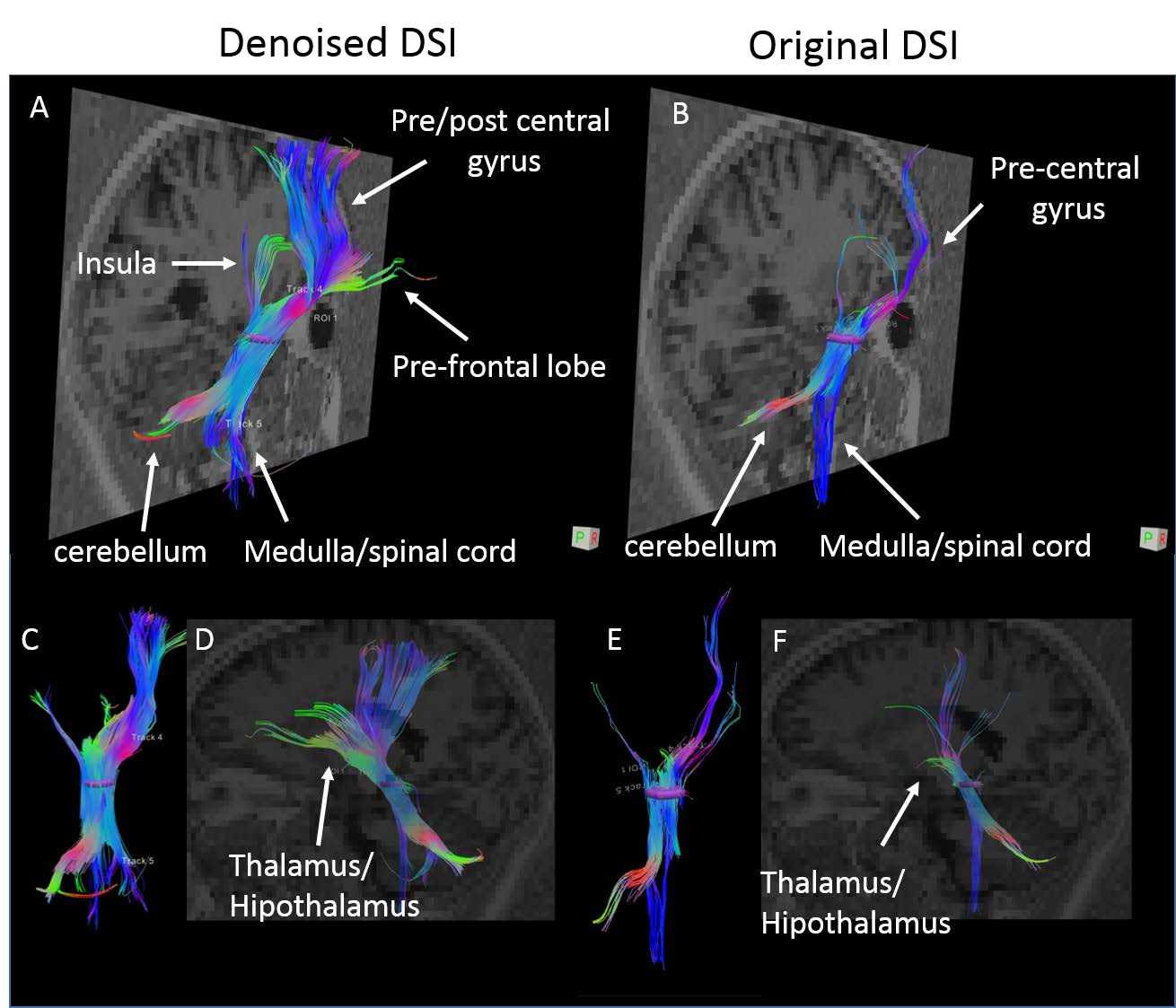 Denoised Diffusion Spectrum Imaging Of White Matter Tracts In The Brain