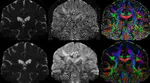 Code for 'Non Local Spatial and Angular Matching : Enabling higher spatial resolution diffusion MRI datasets through adaptive denoising'